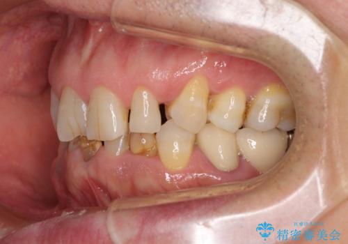 乳歯や矮小歯の多い前歯 部分矯正と補綴治療による審美歯科治療の治療前