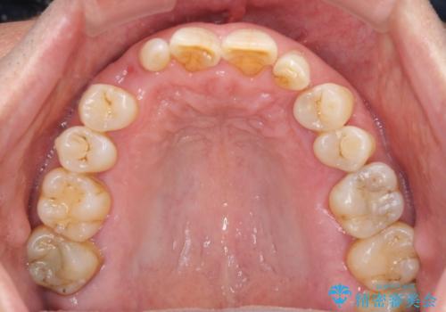 乳歯や矮小歯の多い前歯 部分矯正と補綴治療による審美歯科治療の治療前