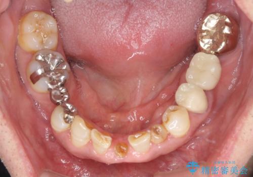 乳歯や矮小歯の多い前歯 部分矯正と補綴治療による審美歯科治療の治療前