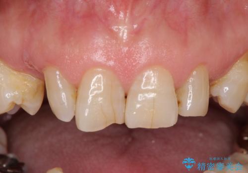 乳歯や矮小歯の多い前歯　部分矯正と補綴治療による審美歯科治療の治療前