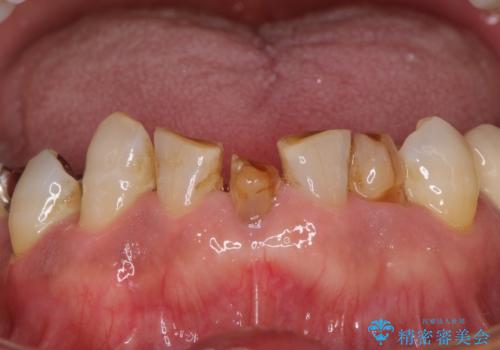 乳歯や矮小歯の多い前歯 部分矯正と補綴治療による審美歯科治療の治療前