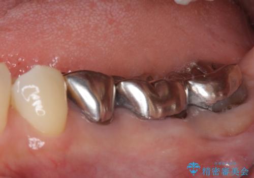 痛む奥歯と見栄えの悪い前歯　オールセラミックによる補綴治療の治療前