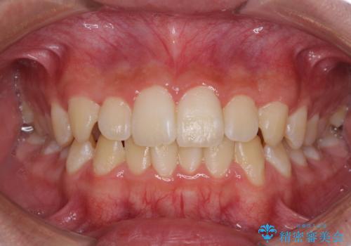 しっかり使って短期間で治療 インビザラインによる叢生解消の症例 治療前