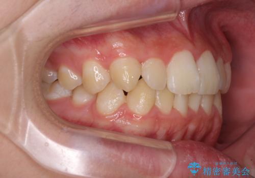 しっかり使って短期間で治療 インビザラインによる叢生解消の治療前
