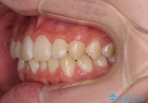 しっかり使って短期間で治療 インビザラインによる叢生解消の治療前