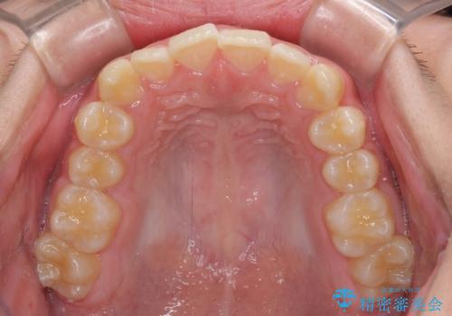 しっかり使って短期間で治療 インビザラインによる叢生解消の治療前