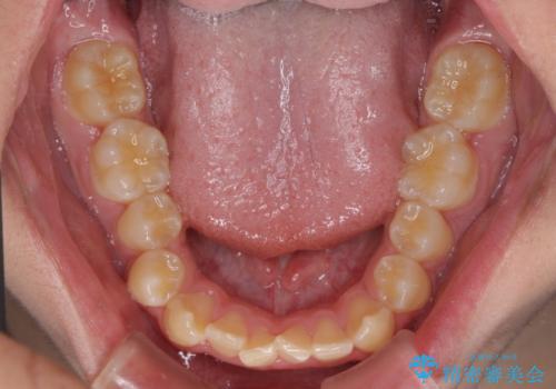 しっかり使って短期間で治療 インビザラインによる叢生解消の治療前