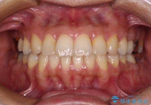 痛む奥歯と矯正の後戻り インビザライン・ライトとセラミック治療の治療後