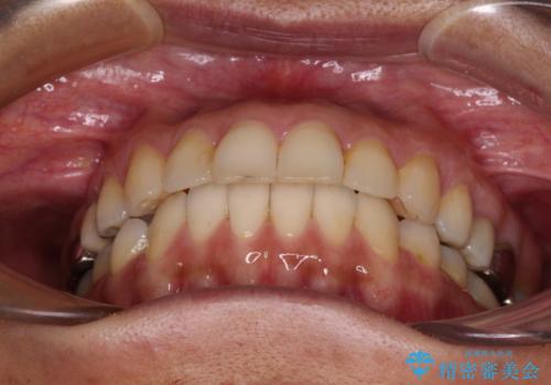 痛む奥歯と矯正の後戻り インビザライン・ライトとセラミック治療の治療後