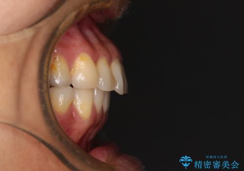 痛む奥歯と矯正の後戻り インビザライン・ライトとセラミック治療の治療後
