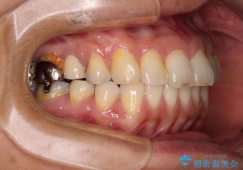 痛む奥歯と矯正の後戻り インビザライン・ライトとセラミック治療の治療後