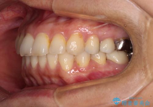 痛む奥歯と矯正の後戻り インビザライン・ライトとセラミック治療の治療後