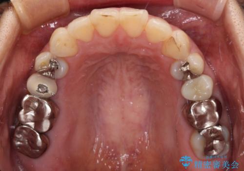 痛む奥歯と矯正の後戻り インビザライン・ライトとセラミック治療の治療後