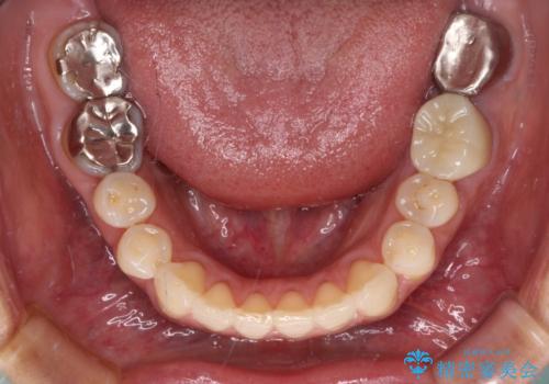 痛む奥歯と矯正の後戻り インビザライン・ライトとセラミック治療の治療後