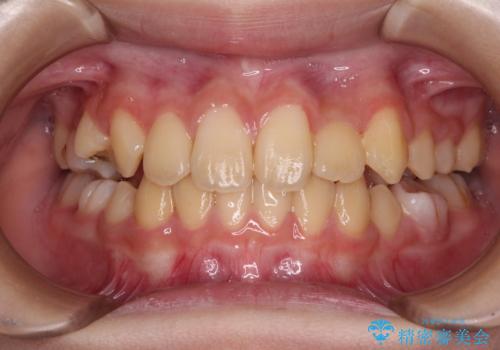 過剰歯を抜歯して前歯を排列　インビザライン・ファーストによる小学生のⅠ期治療