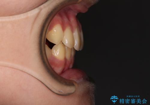 過剰歯を抜歯して前歯を排列 インビザライン・ファーストによる小学生のⅠ期治療の治療後