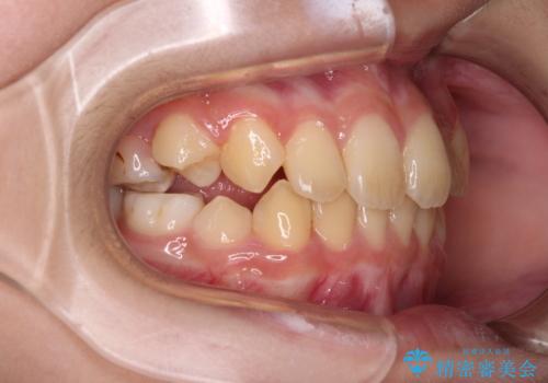 過剰歯を抜歯して前歯を排列 インビザライン・ファーストによる小学生のⅠ期治療の治療後