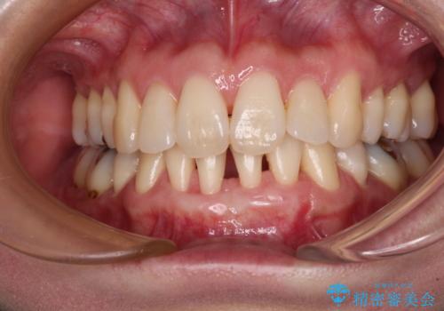 下顎前歯の歯肉退縮 歯肉移植による根面被覆の治療後