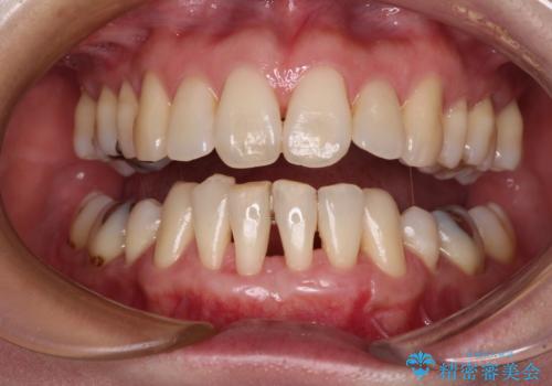 下顎前歯の歯肉退縮 歯肉移植による根面被覆の治療後
