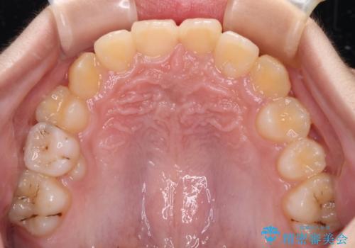 過剰歯を抜歯して前歯を排列　インビザライン・ファーストによる小学生のⅠ期治療の治療後