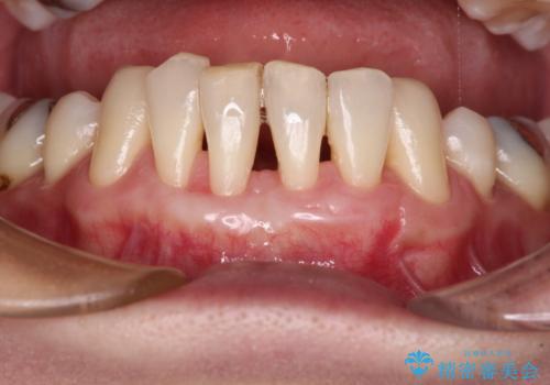 下顎前歯の歯肉退縮　歯肉移植による根面被覆