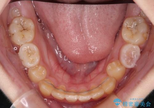 過剰歯を抜歯して前歯を排列 インビザライン・ファーストによる小学生のⅠ期治療の治療後
