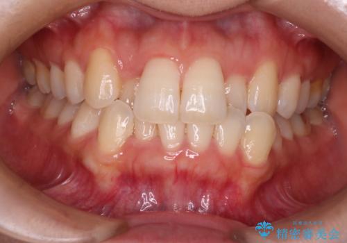 【インビザライン】前歯の凸凹をなおしたいの症例 治療前