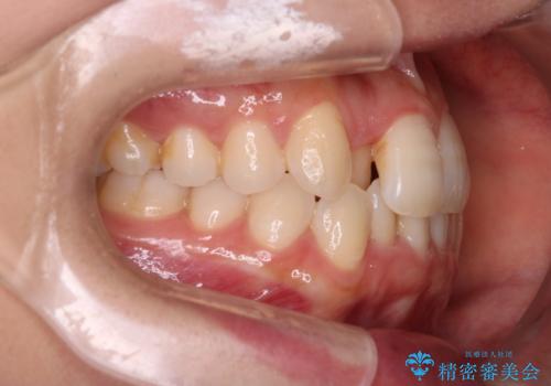 【インビザライン】前歯の凸凹をなおしたいの治療前