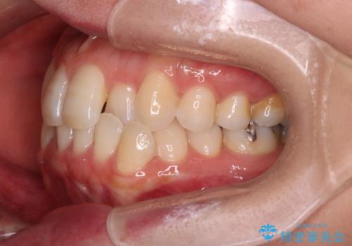 【インビザライン】前歯の凸凹をなおしたいの治療前