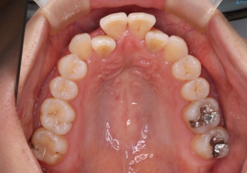 【インビザライン】前歯の凸凹をなおしたいの治療前