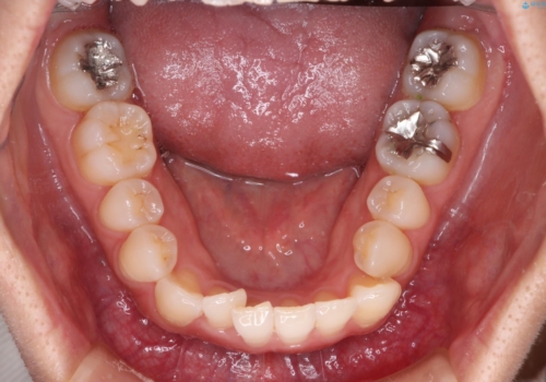 【インビザライン】前歯の凸凹をなおしたいの治療前