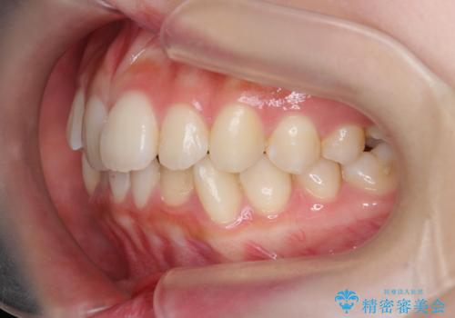 インビザラインライトで行う短期マウスピース矯正治療の治療前