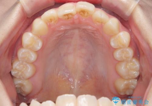 インビザラインライトで行う短期マウスピース矯正治療の症例 治療前