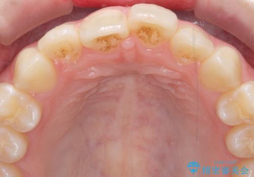 インビザラインライトで行う短期マウスピース矯正治療の治療前