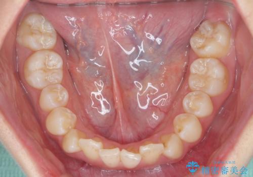インビザラインライトで行う短期マウスピース矯正治療の治療前