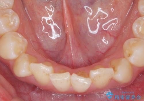 インビザラインライトで行う短期マウスピース矯正治療の治療前