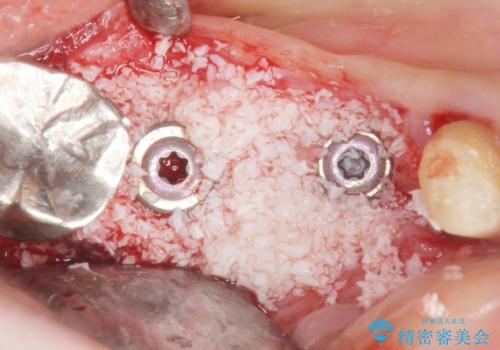 骨が薄く他院でインプラントできないと言われた 50代女性の治療中