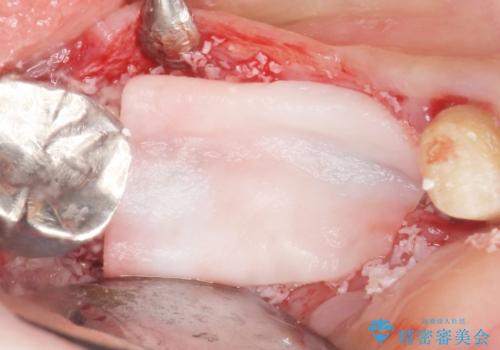 骨が薄く他院でインプラントできないと言われた 50代女性の治療中