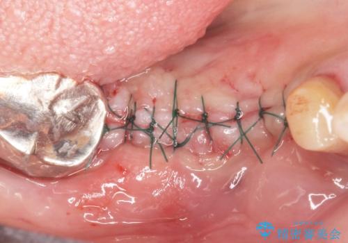 骨が薄く他院でインプラントできないと言われた 50代女性の治療中