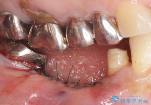 骨が薄く他院でインプラントできないと言われた 50代女性の治療中
