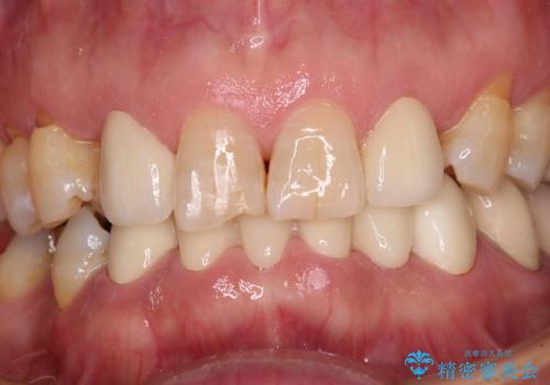 乳歯や矮小歯の多い前歯　部分矯正と補綴治療による審美歯科治療
