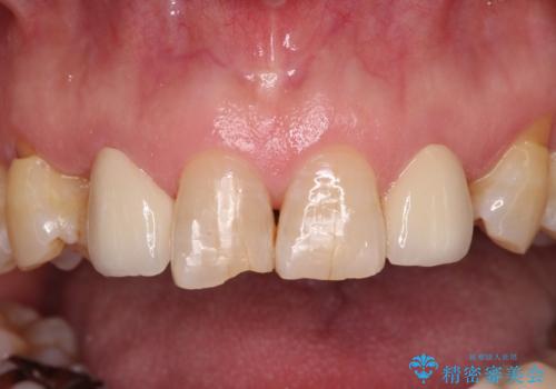 乳歯や矮小歯の多い前歯 部分矯正と補綴治療による審美歯科治療の治療後