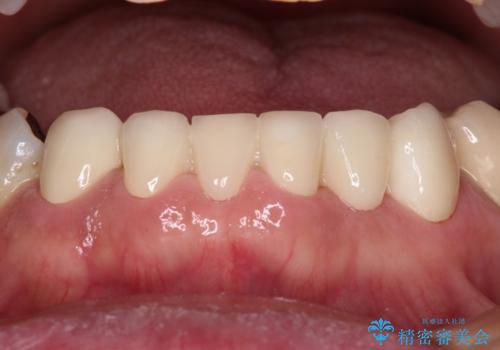 乳歯や矮小歯の多い前歯 部分矯正と補綴治療による審美歯科治療の治療後