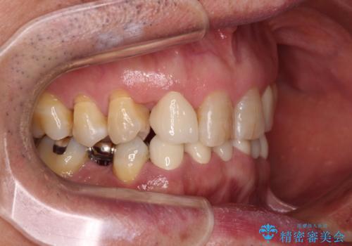 乳歯や矮小歯の多い前歯 部分矯正と補綴治療による審美歯科治療の治療後