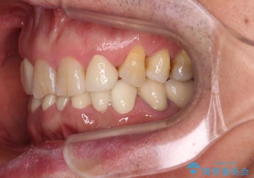 乳歯や矮小歯の多い前歯 部分矯正と補綴治療による審美歯科治療の治療後