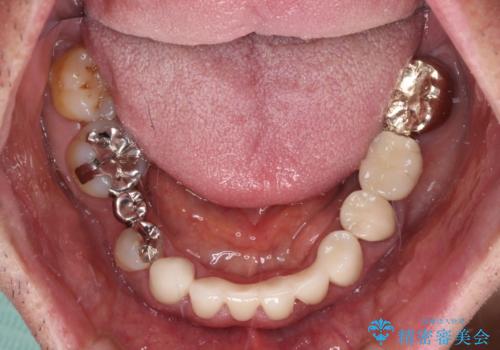 乳歯や矮小歯の多い前歯　部分矯正と補綴治療による審美歯科治療の治療後