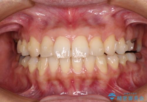 痛む奥歯と矯正の後戻り インビザライン・ライトとセラミック治療の治療中