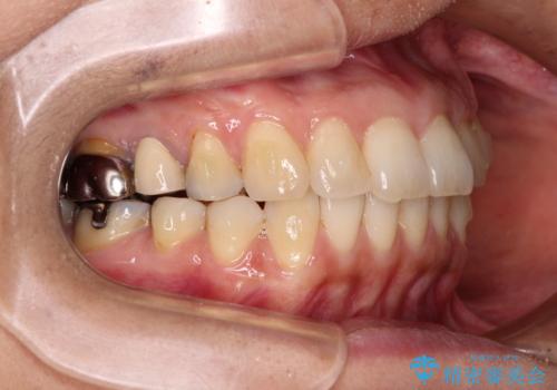 痛む奥歯と矯正の後戻り インビザライン・ライトとセラミック治療の治療中