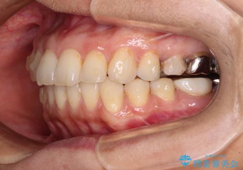 痛む奥歯と矯正の後戻り インビザライン・ライトとセラミック治療の治療中