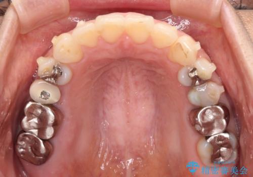 痛む奥歯と矯正の後戻り インビザライン・ライトとセラミック治療の治療中